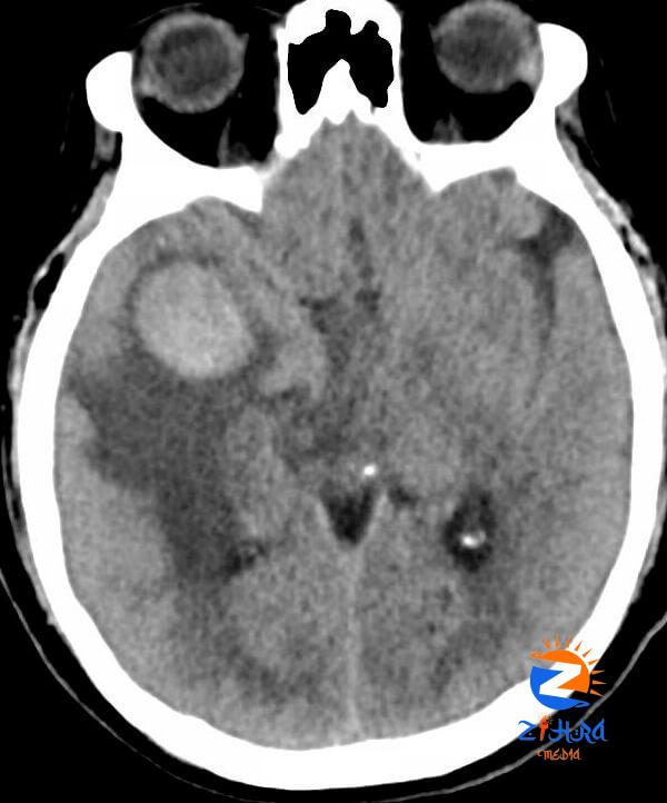 Clinical Challenge: Generalized Weakness and Dehydration