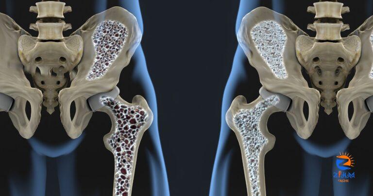 Osteoporosis | Endocrine Society