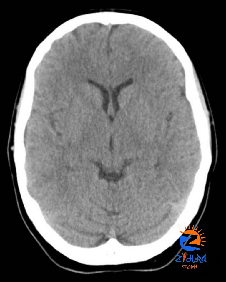 Clinical Challenge: Lower Limb Weakness