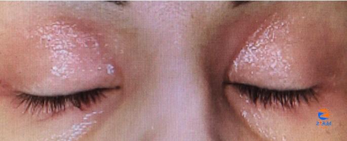 Clinical Challenge: Bilateral Itchy, Watery Eyes