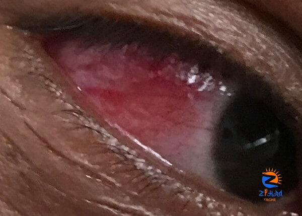 Clinical Challenge: Painful Red Eye