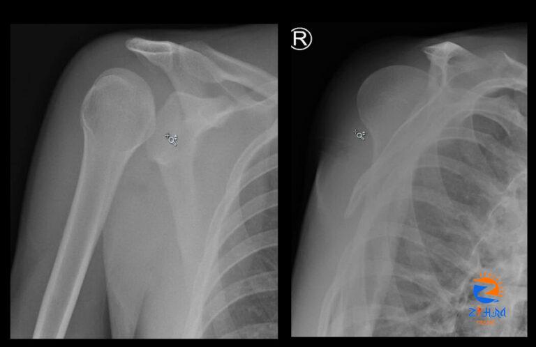 Clinical Challenge: Shoulder Injury – Clinical Advisor