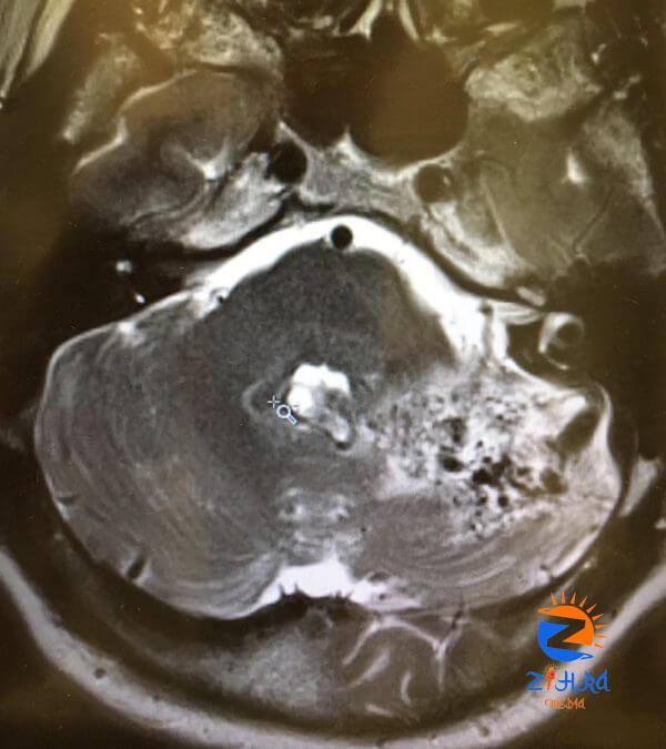 Clinical Challenge: Bilateral Blurry Vision