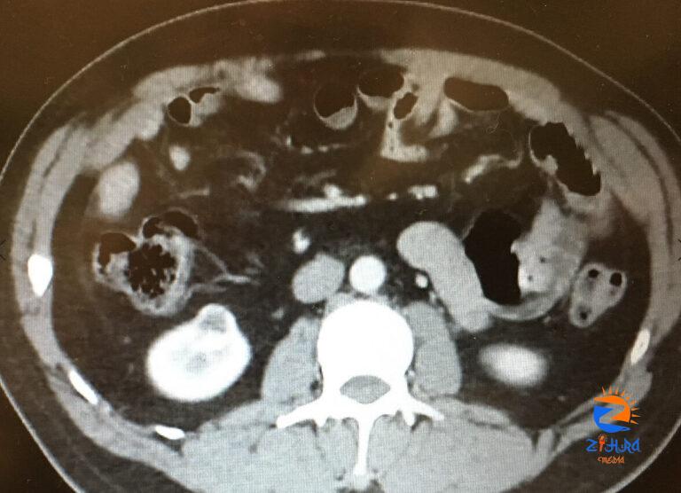 Clinical Challenge: Acute Left Lower Quadrant Pain