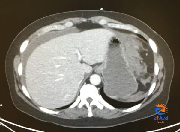 Generalized Epigastric Pain and Syncope