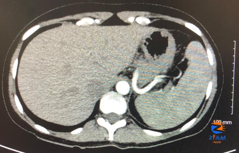 Chest Pain, Shortness of Breath, and Nausea