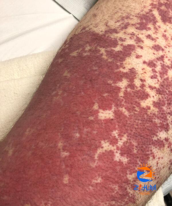 Clinical Challenge: Violaceous Rash – Clinical Advisor