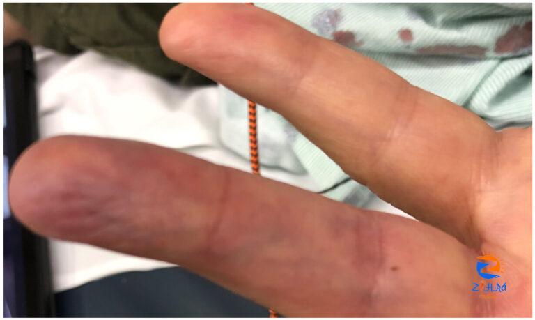 Clinical Challenge: Ring Finger Pain