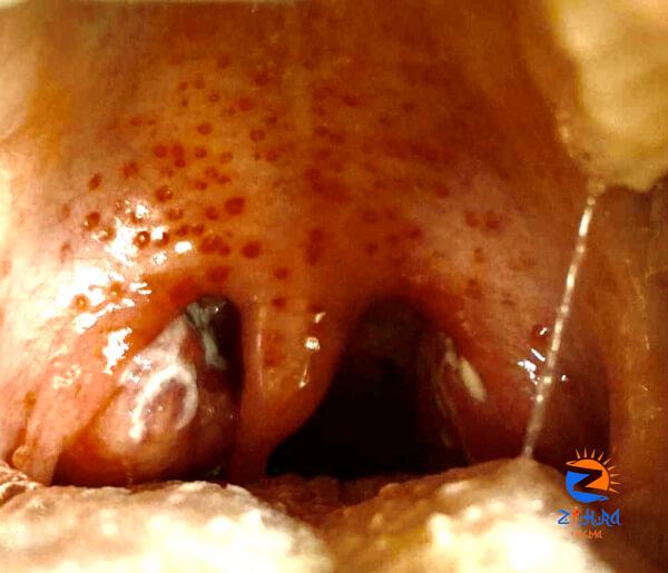 Clinical Challenge: Spots on Throat