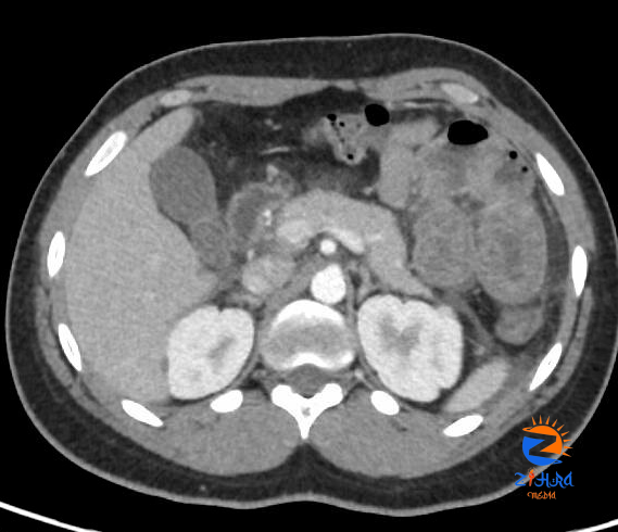 Clinical Challenge: Recurrent Abdominal Pain