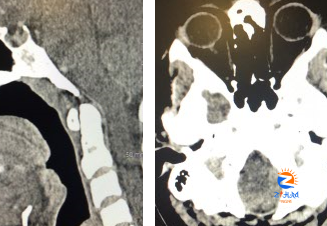 Clinical Challenge: Headache With Transient Drooling