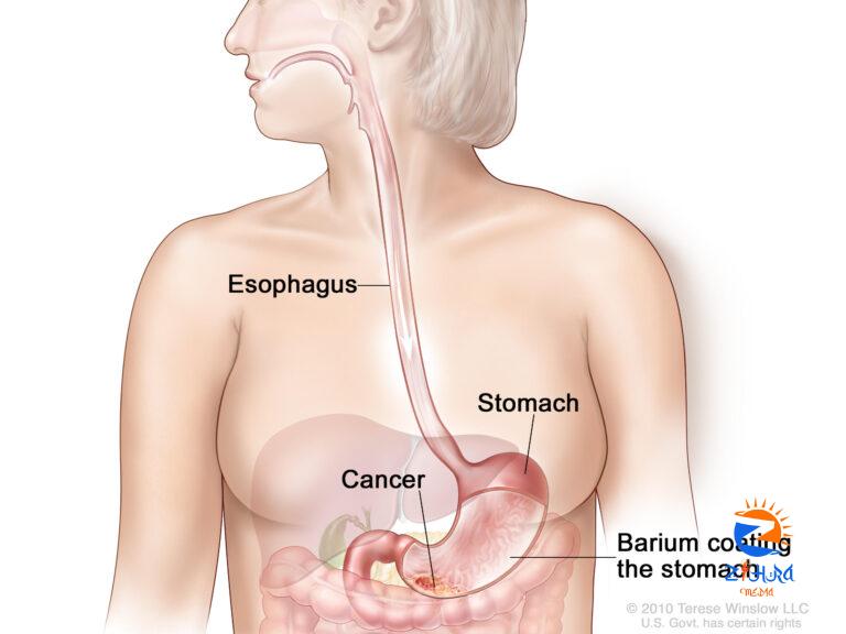 Stomach Cancer Diagnosis and Tests