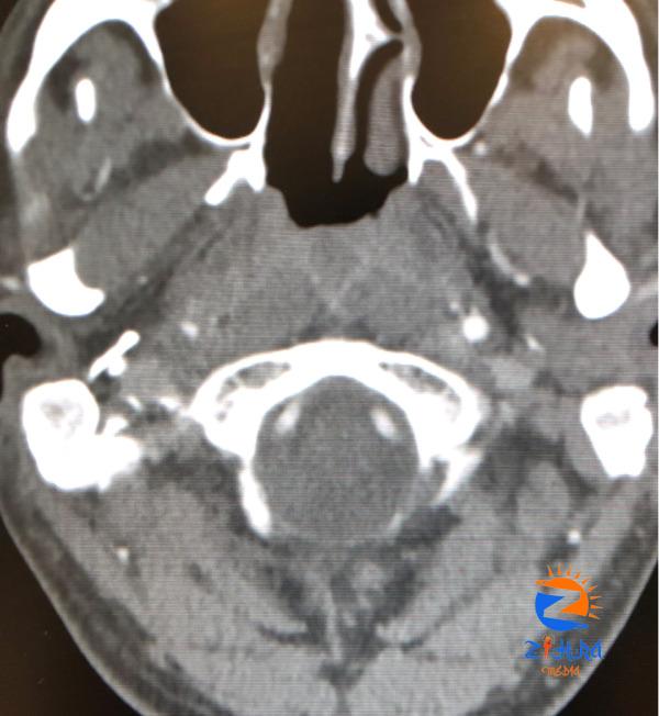 Clinical Challenge: Blunt Trauma to Head and Neck