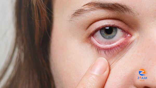 Conjunctivitis alert: Follow these tips to prevent red eye infection