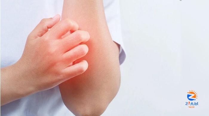 What triggers itchiness in skin conditions like eczema?