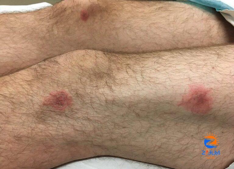 Case Study: A gradually progressive rash after a URI