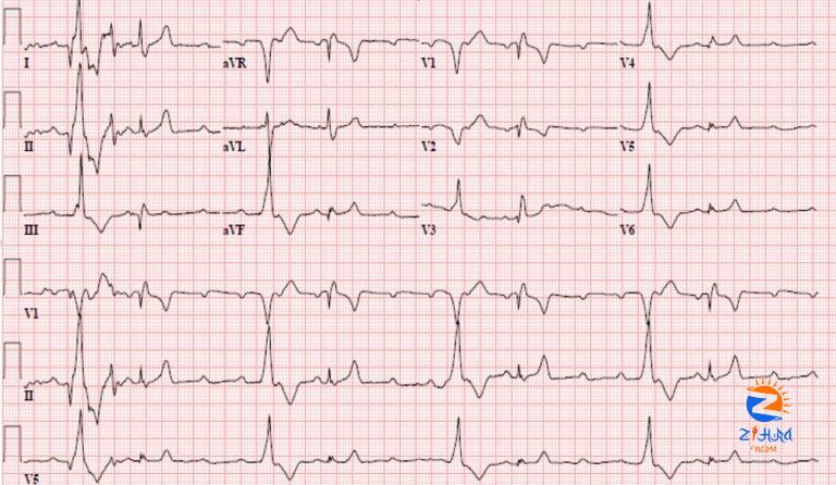 Case Study: Syncope, Dizziness, and Fatigue on a Camping Trip