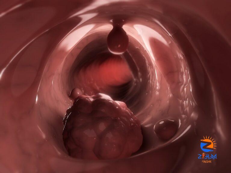 Case Study: Chest Pain and Shortness of Breath in a Patient with Colorectal Cancer