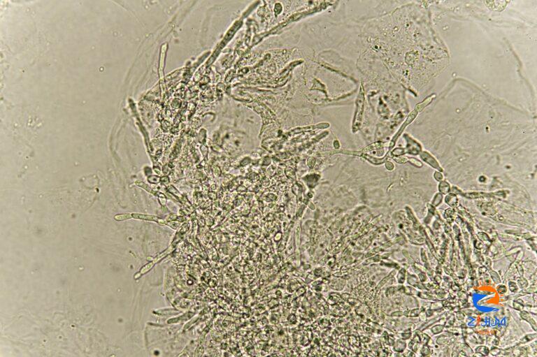 Case Study in Diabetes: Fungal Infections