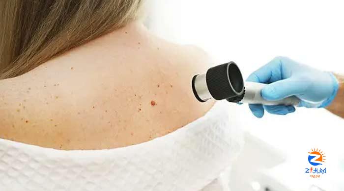 Melanoma skin cancer to reach record high rates