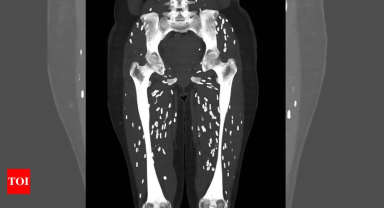 Google: ‘One of the craziest CT scans’: Doctor shares pictures of patient’s legs filled with parasites